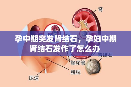 孕中期突发肾结石，孕妇中期肾结石发作了怎么办 