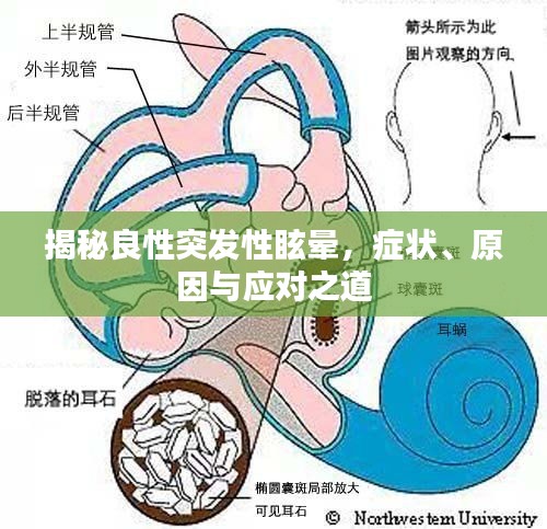 揭秘良性突发性眩晕，症状、原因与应对之道