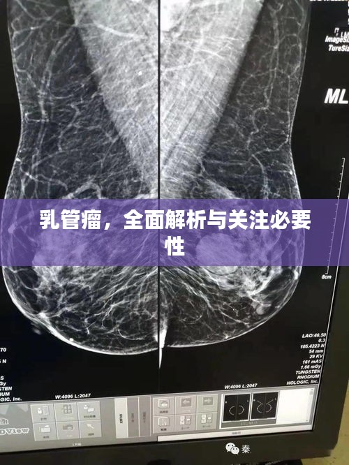 乳管瘤，全面解析与关注必要性